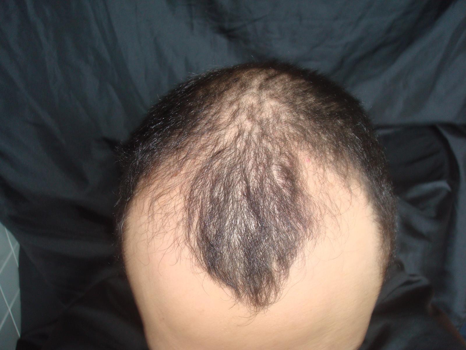 Real case photograph showing the starting hair-loss pattern