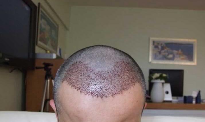 Real case photograph showing the early post-procedure recipient area