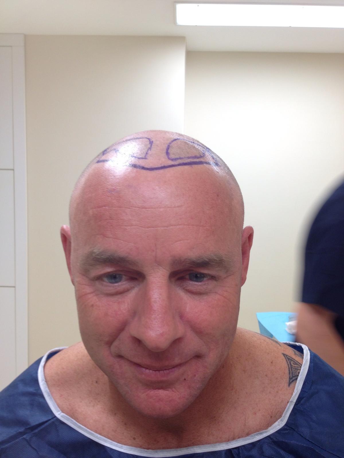 Real case photograph showing pre-procedure hairline planning